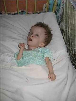 ребёнок  с гидроцефалией  в  кровати